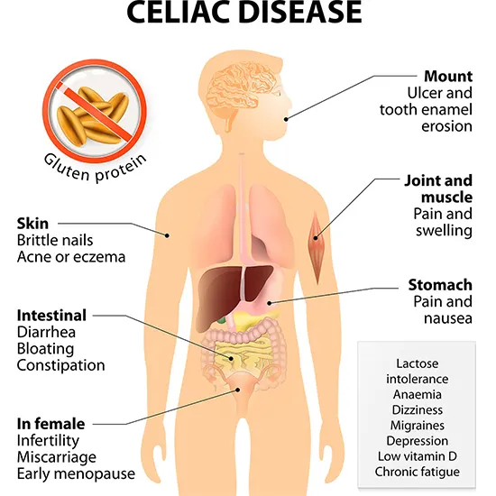 Celiac Disease Comprehensive Profile